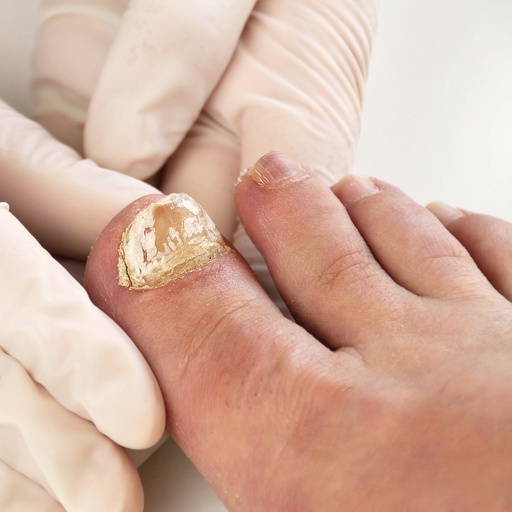 Treatment of 1 nail with onycholysis or fungus problem 10-20euro