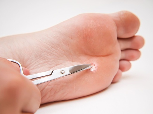 Treatment of 1 separate area without pedicure(calluses ,cracks, corns) 20-35euro