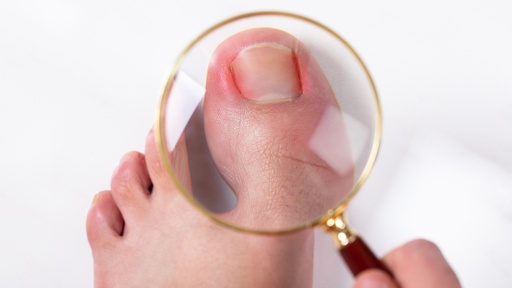 Treatment of ingrown toenail with inflammation 20euro